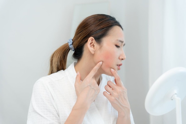ragazza che si guarda allo specchio con couperose