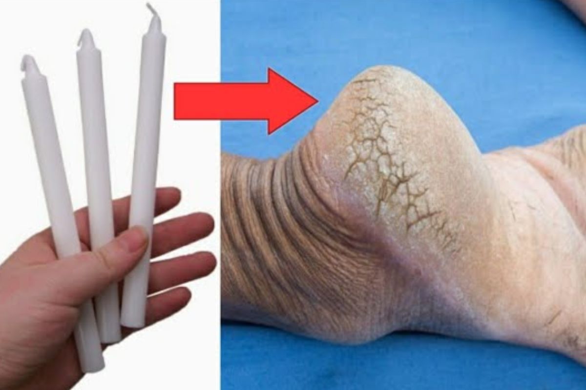 Talloni screpolati? Procurati una candela: te ne sbarazzi in un solo giorno