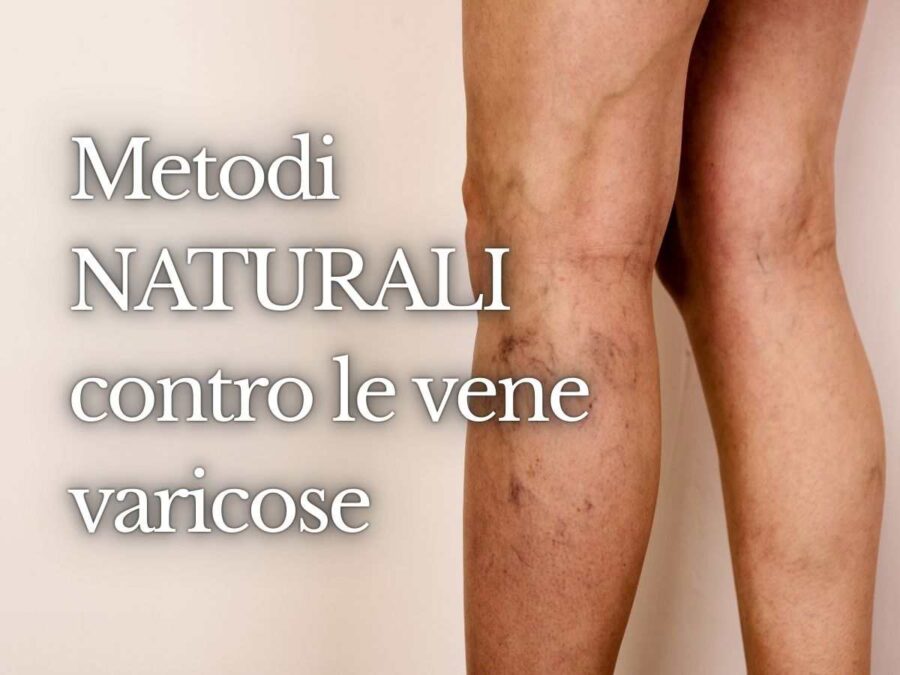 donna con vene varicose